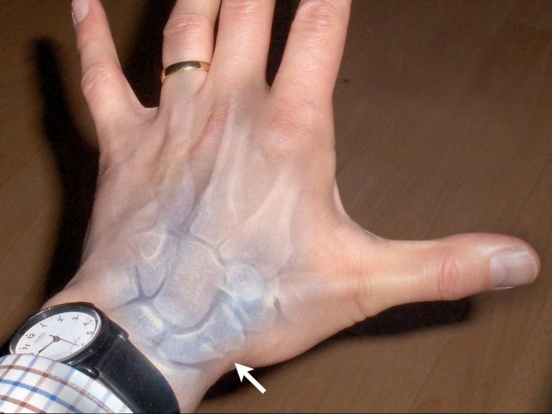 四川友誼醫(yī)院成功開展微創(chuàng)腕舟骨骨折空心釘固定手術(shù)