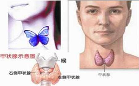 焦慮、疲倦、出汗、脖子粗大，警惕甲狀腺功能亢進