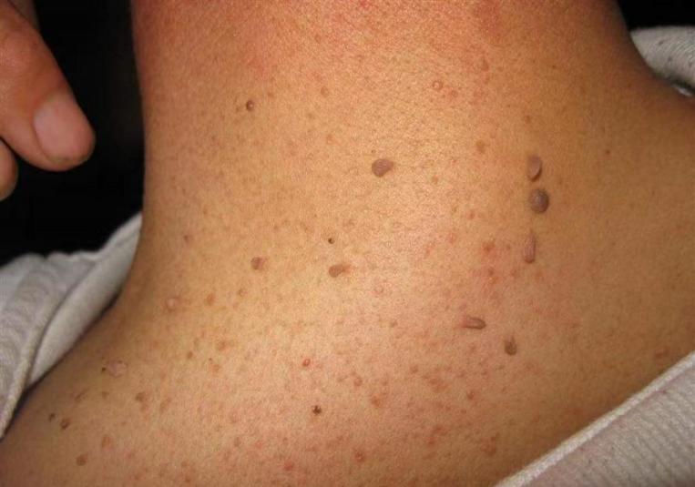 你知道什么是皮贅[zhuì]嗎？