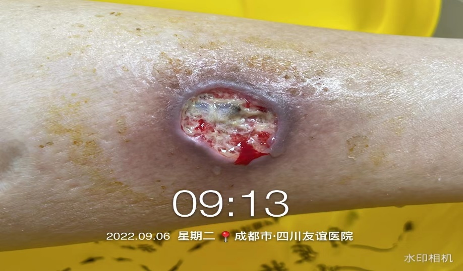 四川友誼醫(yī)院傷口造口門診收治第一例傷口住院患者