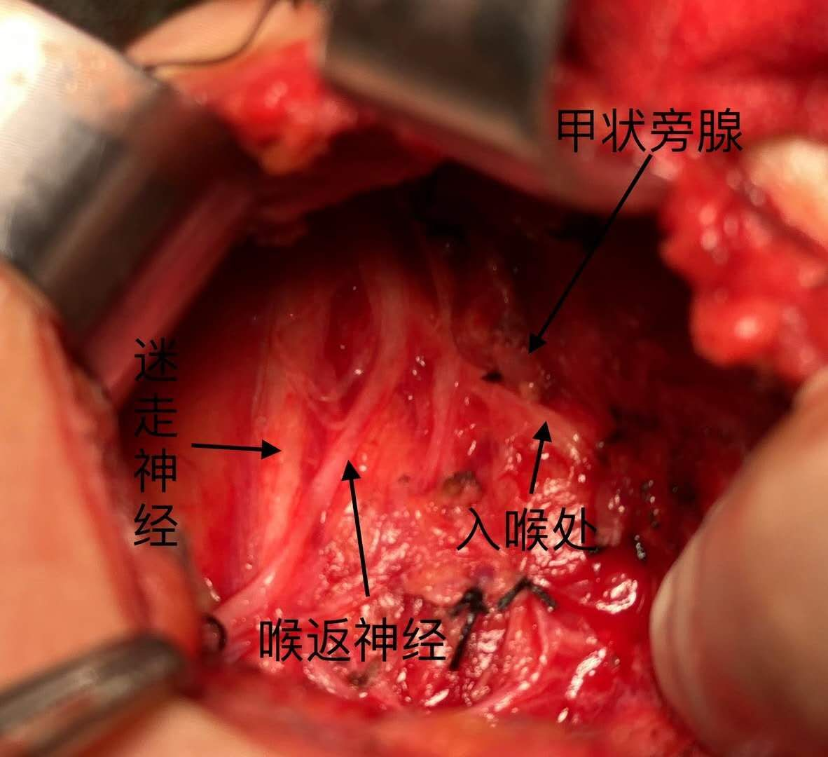 繼發(fā)性甲狀旁腺功能亢進(jìn)的手術(shù)治療