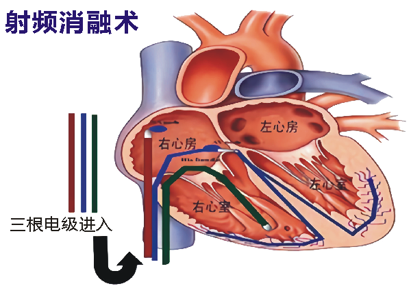 心導(dǎo)管射頻消融術(shù)