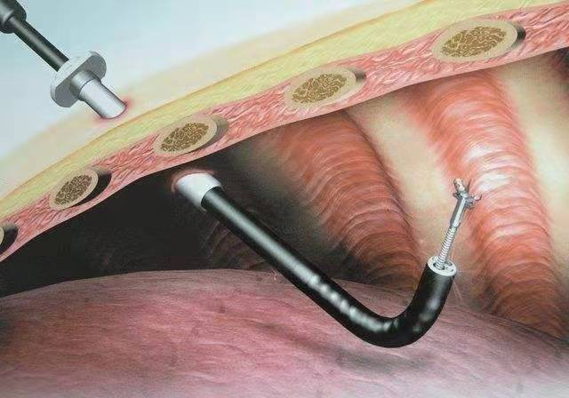 內(nèi)科胸腔鏡