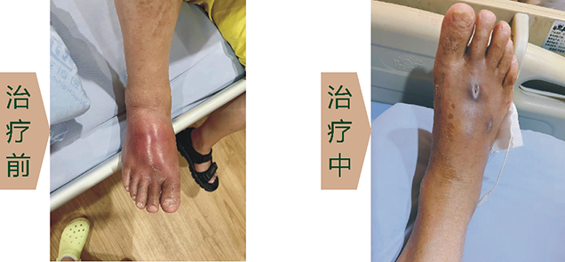 糖尿病足治療前、中、后對(duì)比
