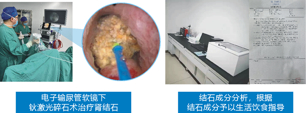 泌尿系結(jié)石的各種微創(chuàng)手術(shù)治療