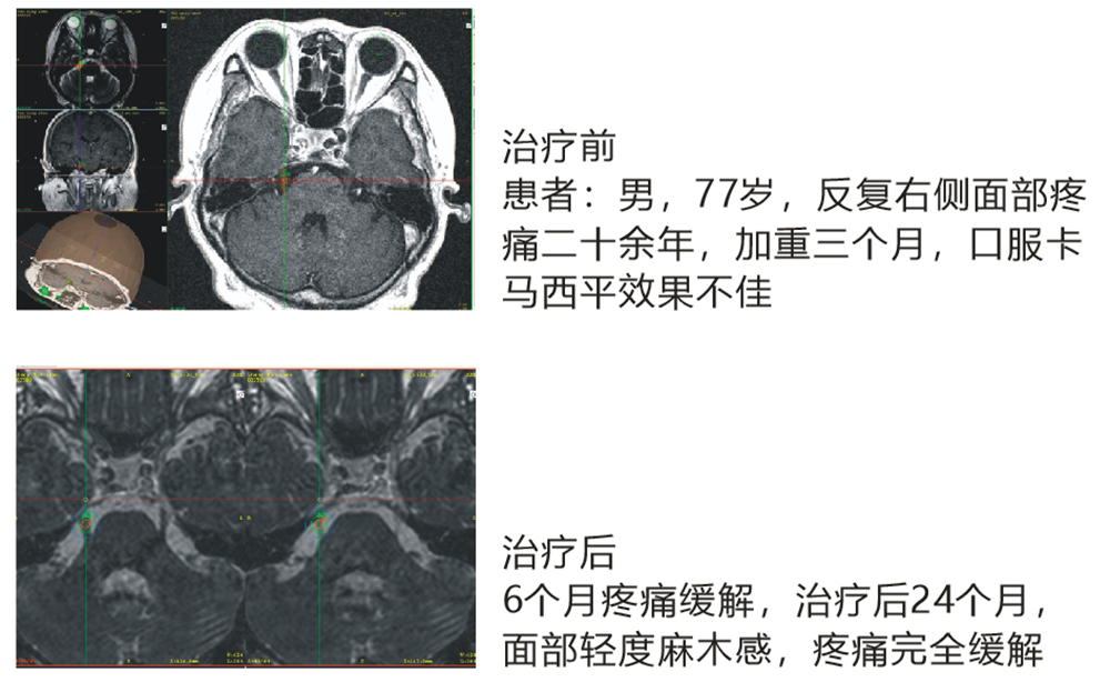 三叉神經(jīng)痛