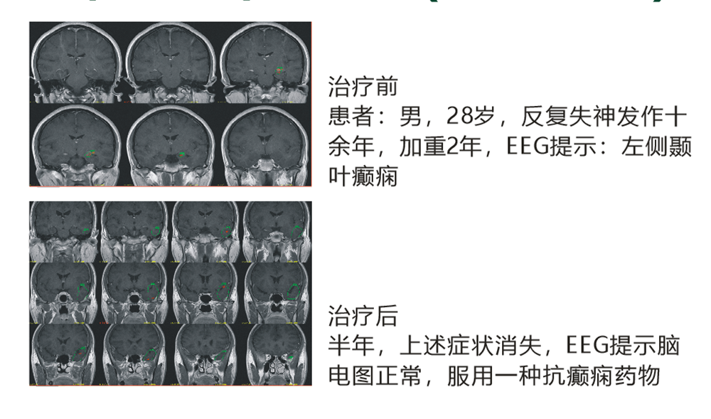 藥物難治性癲癇（顳葉癲癇）