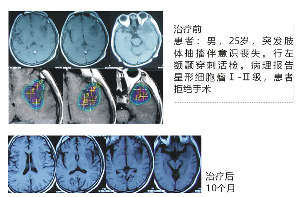 膠質(zhì)瘤