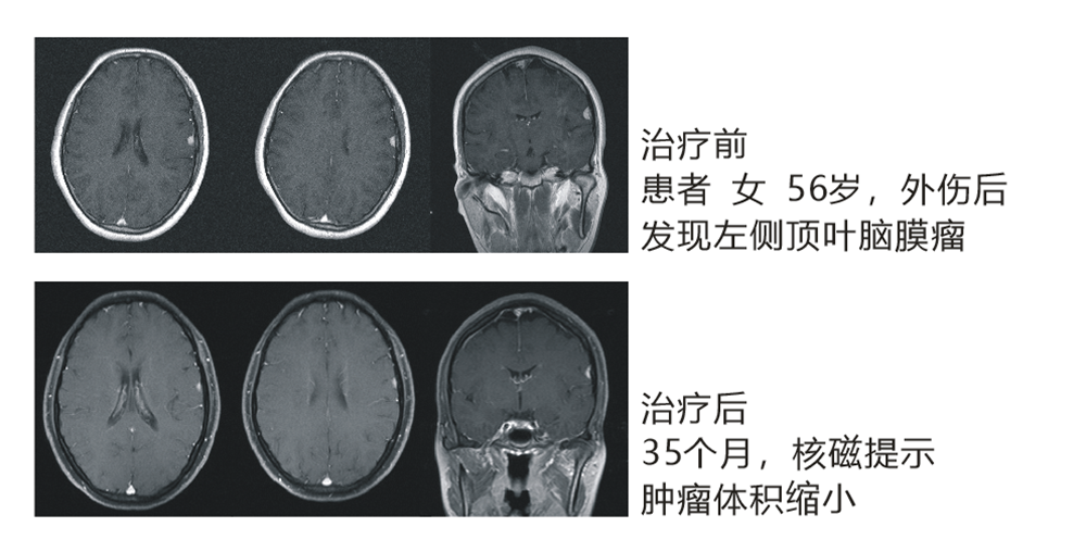 左側(cè)頂葉腦膜瘤
